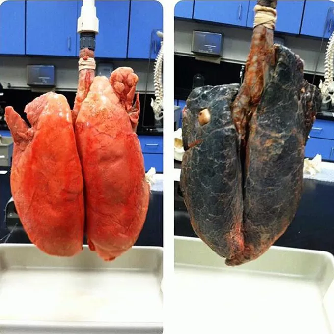 Smokers Lungs